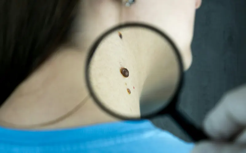 A mole on a patient's neck seen through a magnifying glass